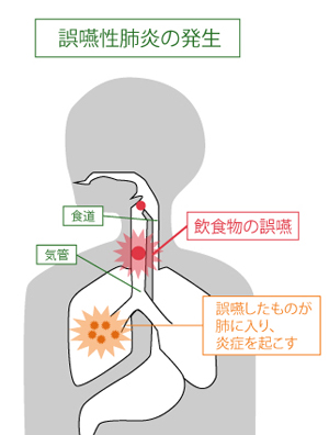 誤嚥性肺炎について